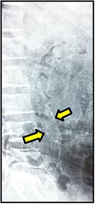 Association of Serum Osteoprotegerin Level With Myocardial Injury and Cardiovascular Calcification in Chronic Kidney Disease Patients